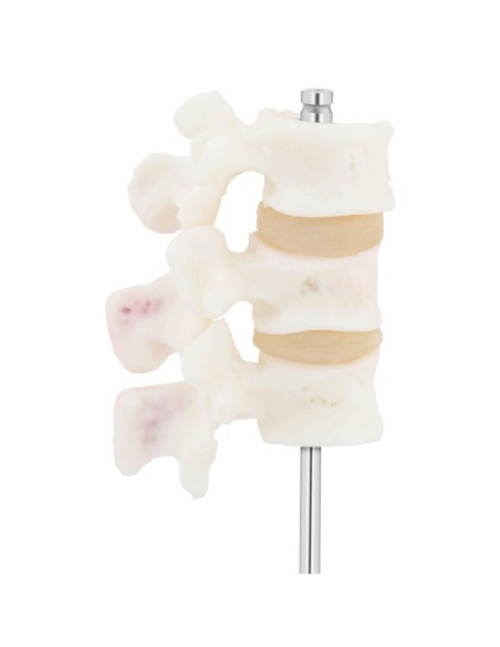 Juosmens osteoporozės slankstelių 3D anatominis modelis 3-5 Juosmens osteoporozės slankstelių 3D anatominis modelis 3-5