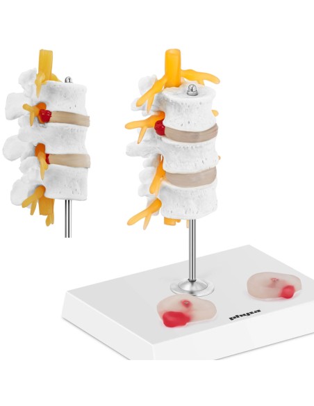 3D anatominis stuburo juosmeninės dalies modelis su išvaržuotais slanksteliais 3-5 3D anatominis stuburo juosmeninės dalies modelis su išvaržuotais slanksteliais 3-5