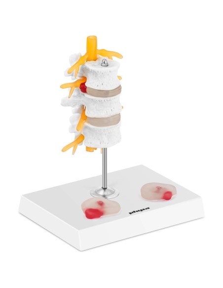 3D anatominis stuburo juosmeninės dalies modelis su išvaržuotais slanksteliais 3-5 3D anatominis stuburo juosmeninės dalies modelis su išvaržuotais slanksteliais 3-5