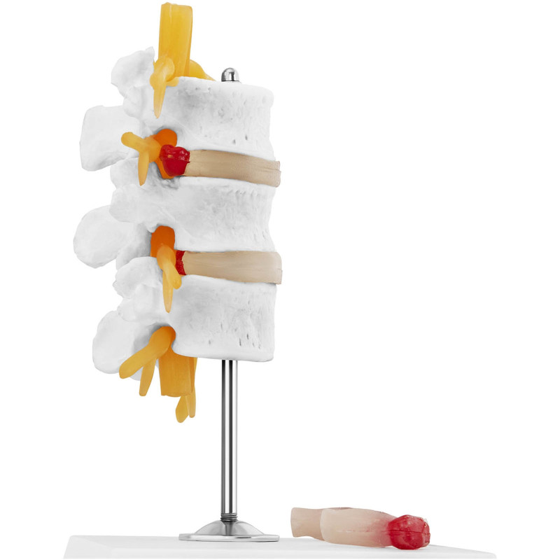 3D anatominis stuburo juosmeninės dalies modelis su išvaržuotais slanksteliais 3-5