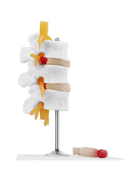 3D anatominis stuburo juosmeninės dalies modelis su išvaržuotais slanksteliais 3-5 3D anatominis stuburo juosmeninės dalies modelis su išvaržuotais slanksteliais 3-5