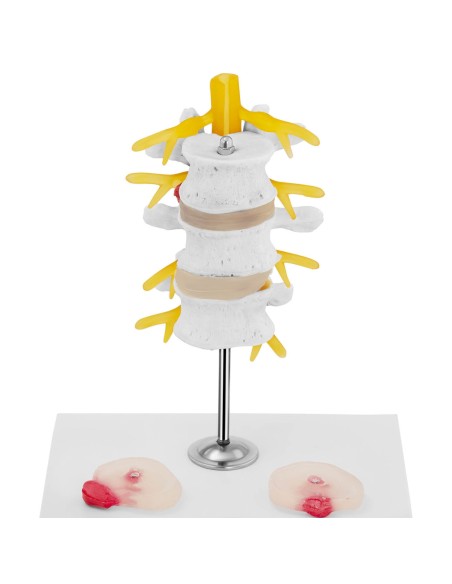 3D anatominis stuburo juosmeninės dalies modelis su išvaržuotais slanksteliais 3-5 3D anatominis stuburo juosmeninės dalies modelis su išvaržuotais slanksteliais 3-5