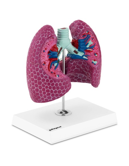 3D anatominis žmogaus plaučių modelis su pažeidimais 3D anatominis žmogaus plaučių modelis su pažeidimais