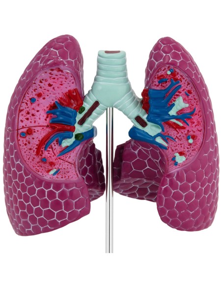 3D anatominis žmogaus plaučių modelis su pažeidimais 3D anatominis žmogaus plaučių modelis su pažeidimais
