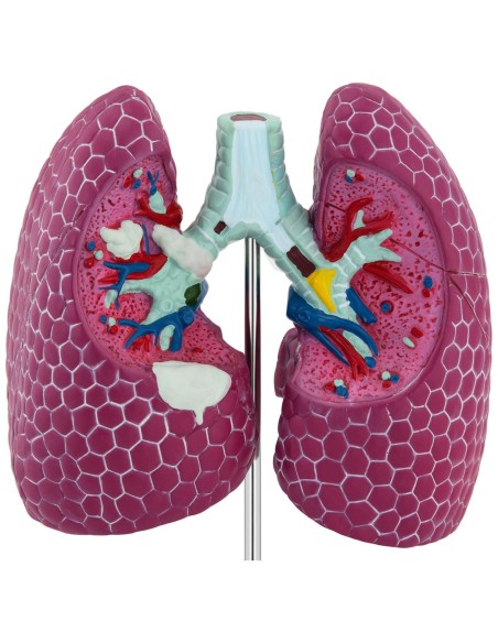 3D anatominis žmogaus plaučių modelis su pažeidimais 3D anatominis žmogaus plaučių modelis su pažeidimais